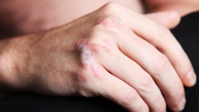 פסוריאזיס – לא מה שחשבתם